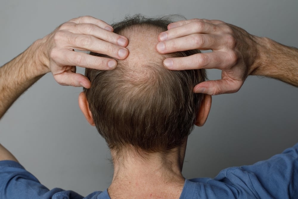 FDA Expands Approval Of Eli Lilly's Olumiant For Adolescents with Autoimmune Hair Loss