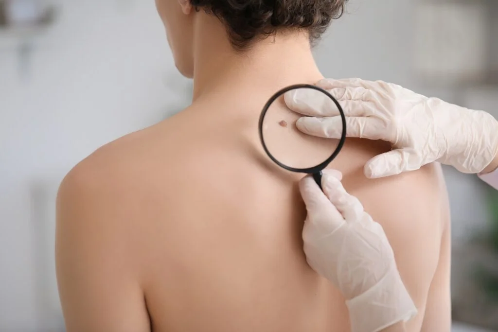 Melanoma Data Study Boosts J&amp;J Partner Nanobiotix Stock On Thursday