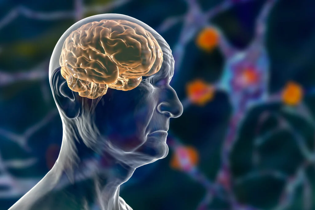 Anavex Life Lead Drug Targets Early Alzheimer's Cause - New Study Highlights