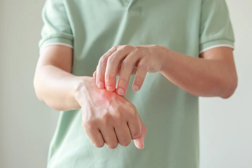 Corvus Stock Spikes On Heels Of Strong Eczema Study Results