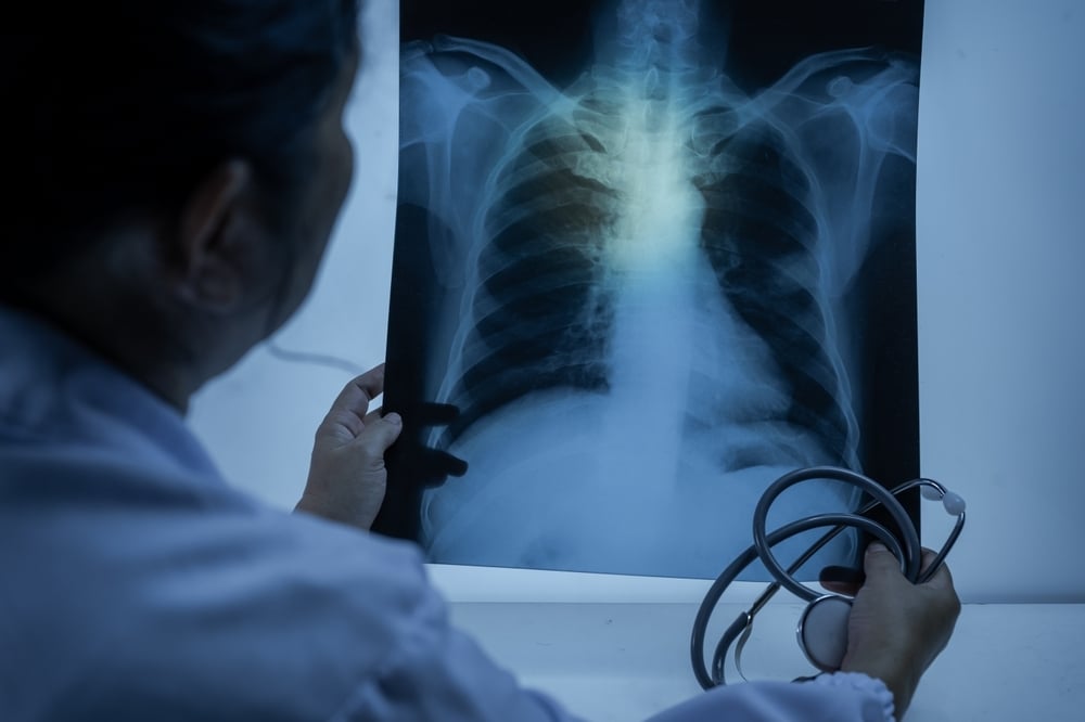 Abbisko, AstraZeneca Team Up on Lung Cancer Drug Combo After China Trial Clearance